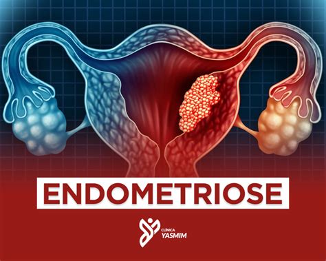 endometriose o que é - o que e faixa de gaza